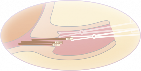 Dilapan-S » accretio medical GmbH